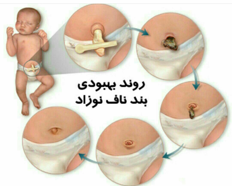 زمان افتادن بندناف نوزاد کی هست؟