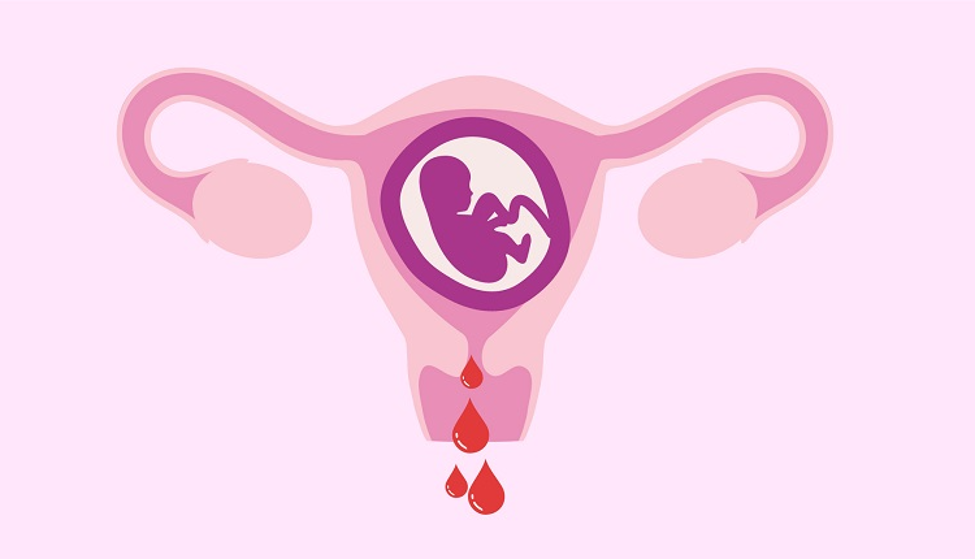 تأثیر خونریزی دوران بارداری در سلامت مادر و جنین