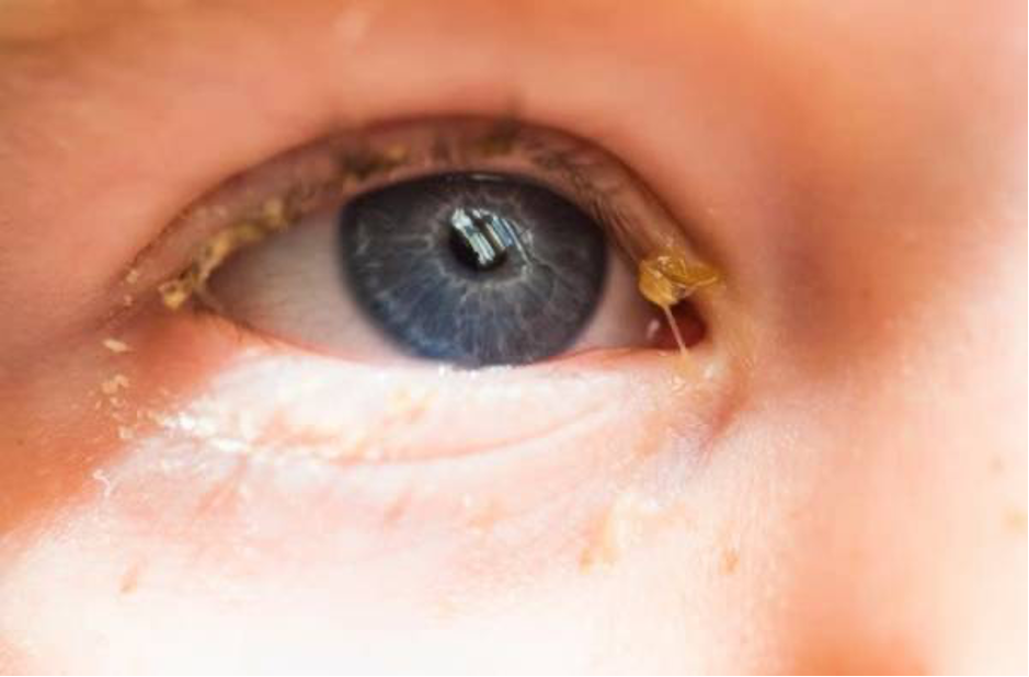 درمان خانگی عفونت چشم