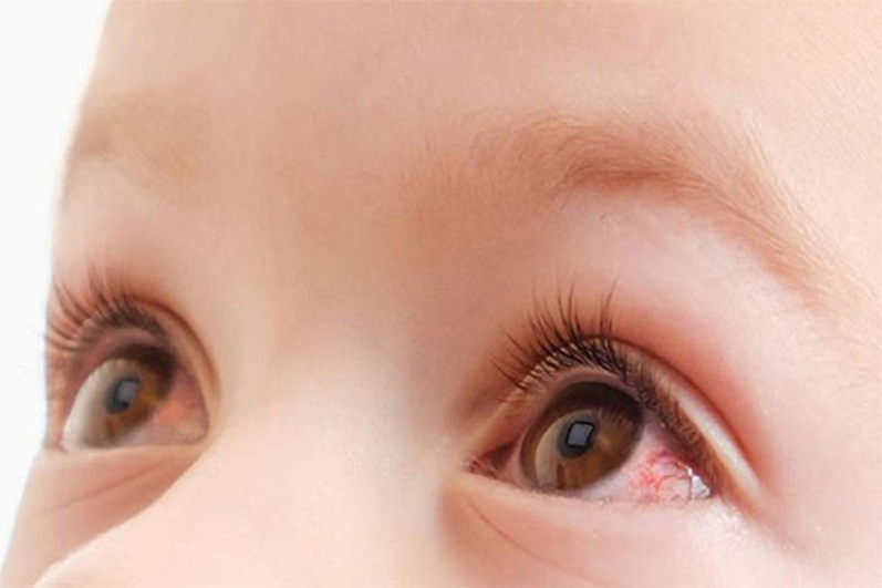 تشخیص عفونت چشمی ویروسی در کودکان