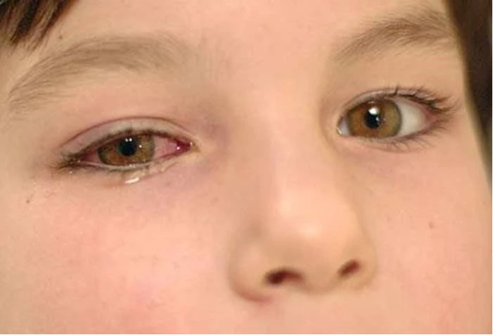 آماری از کودکانی که به عفونت چشم در کودکان دچار می‌شوند