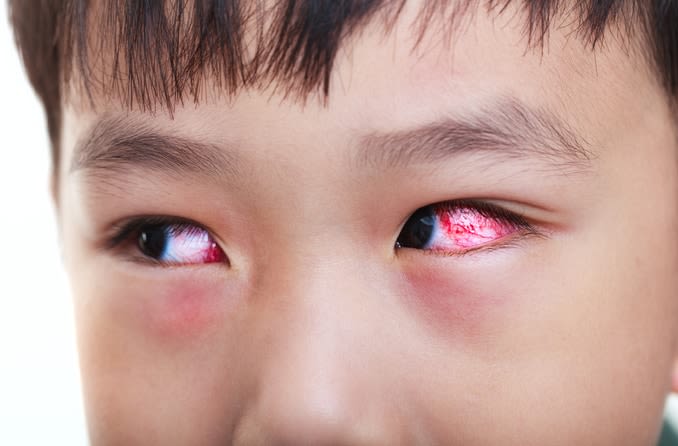 چه زمانی برای التهاب چشم کودک باید به پزشک مراجعه کرد؟
