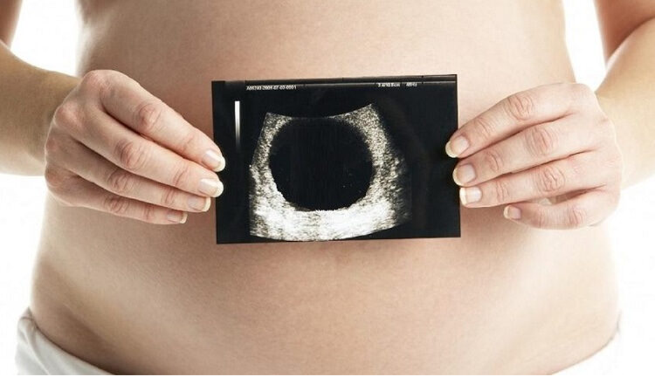 پیامدهای حاملگی پوچ برای باروری زنان