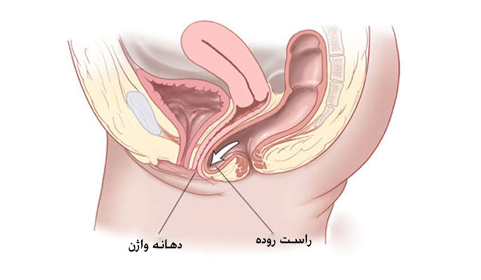 انواع افتادگی مثانه