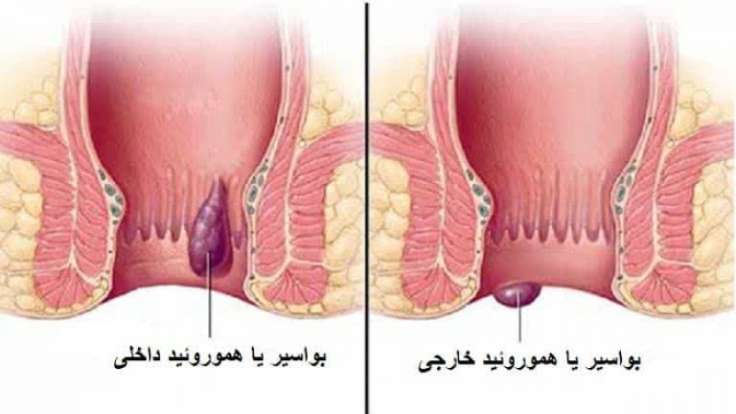معایب رابطهمقعدی