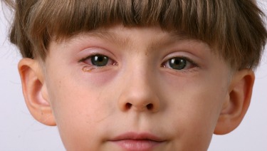 التهاب در اثر قطره‌های چشمی آنتی‌بیوتیک