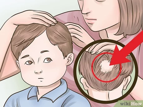 ریزش مو در کودکان