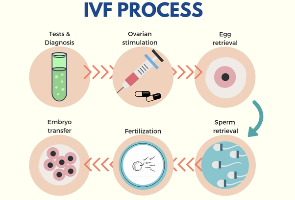 لقاح مصنوعی IVF
