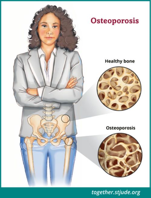 پوکی استخوان Osteoporosis چیست؟
