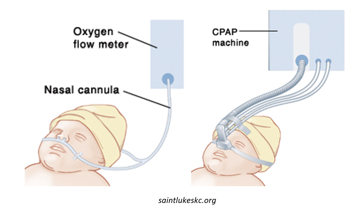 کمک به تنفس در نوزادان تاکی پنه