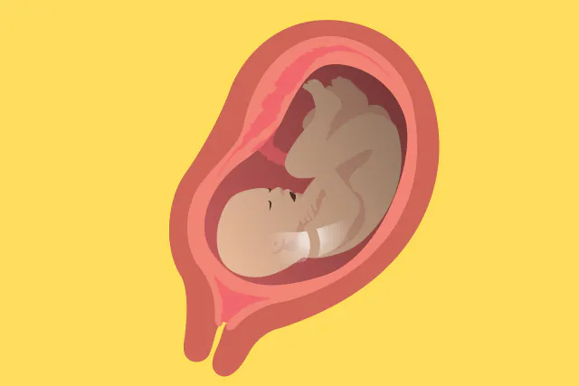 پارگی زودرس کیسه آب جنین (Pprom) چیست؟