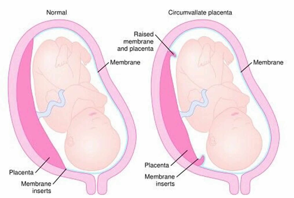 جفت خندقی Placenta Circumvallate چیست؟