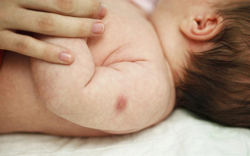 واکسن ب ث ژ در بدو تولد و علت ماندن جای واکسن