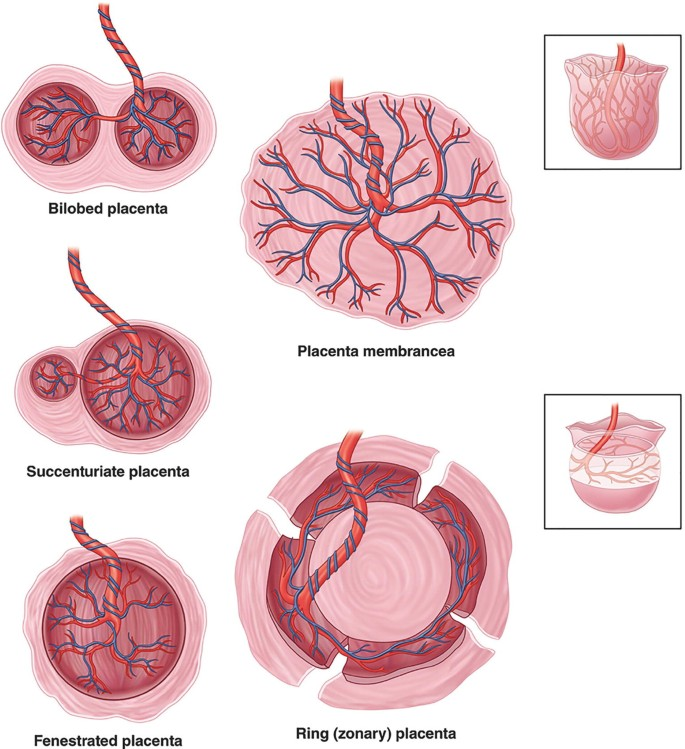جفت فنستراتا (جفت غربالی یا مشبک) Placenta Fenestrata