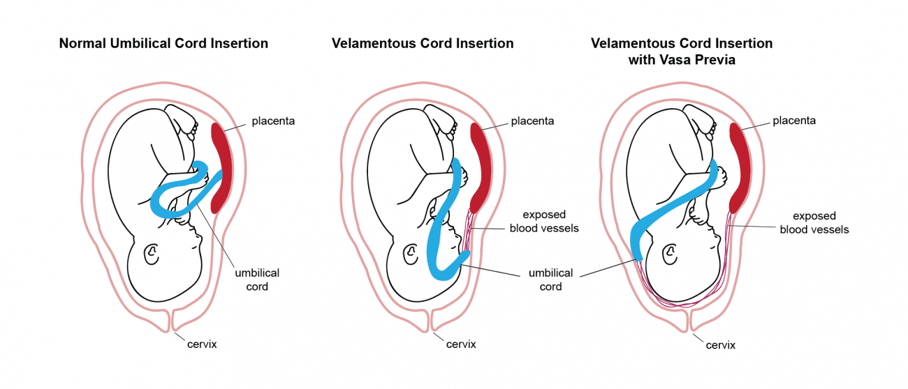 جفت راکتی  Battledore Placenta