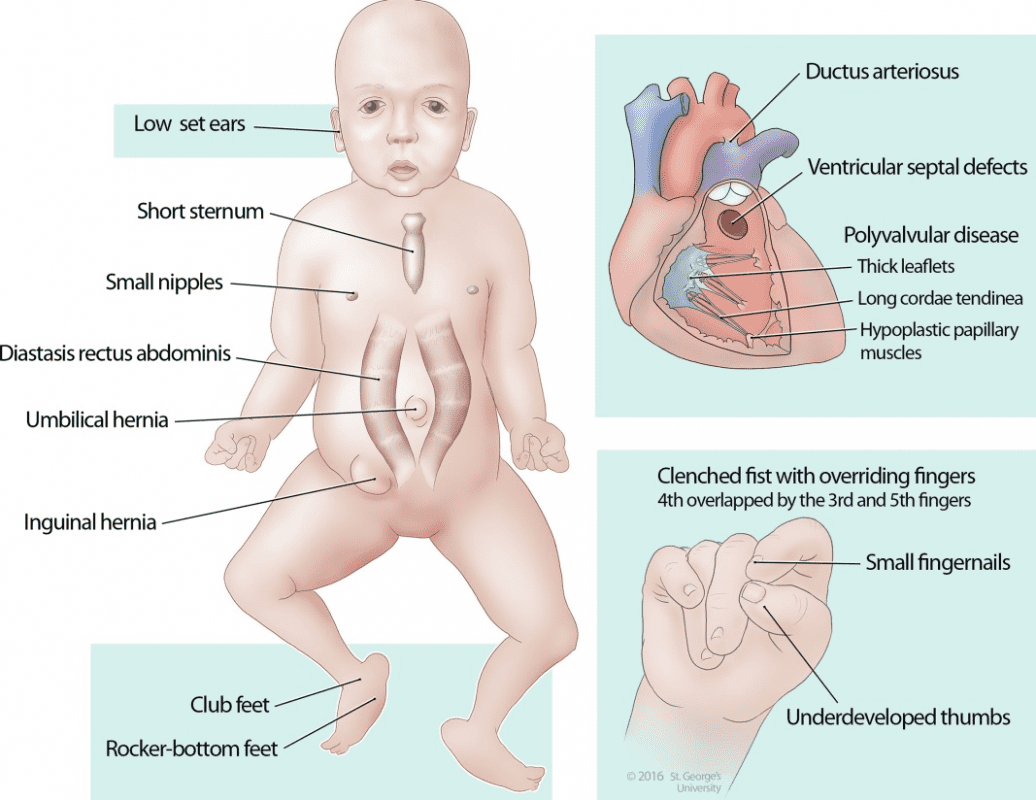 ویژگی‌های سندرم ادواردز (تریزومی 18) پس از تولد