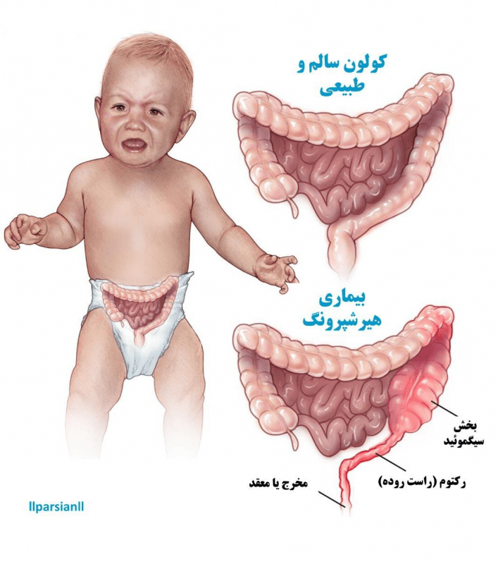 سندرم هیرشپرونگ: علائم، علل، تشخیص و درمان - پینو بیبی