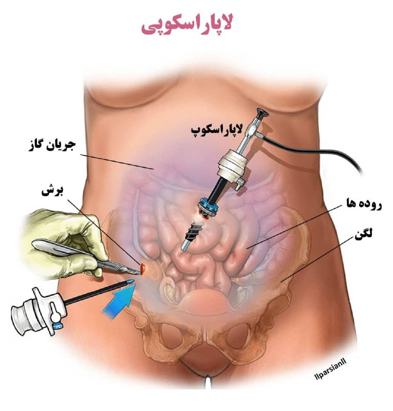 چگونگی آمادگی برای انجام لاپاراسکوپی