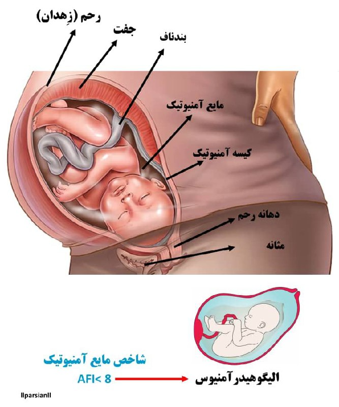 الیگوهیدرآمنیوس چیست؟