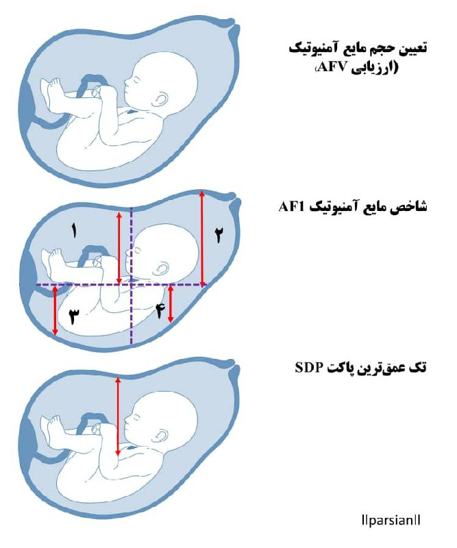 تشخیص الیگوهیدرآمنیوس در دوران بارداری