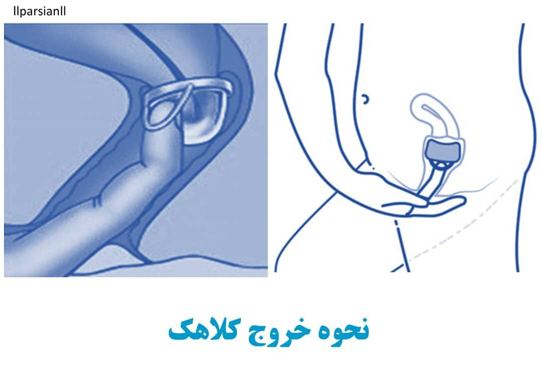 نحوه خروج کلاهک