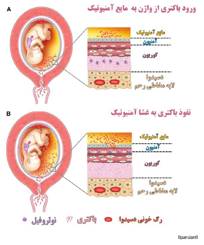 علل کوریوآمنیونیت چیست؟