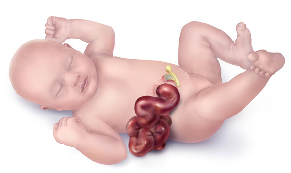 گاستروشیزیس در نوزادان