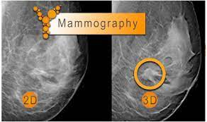 انواع مختلف ماموگرافی چیست؟