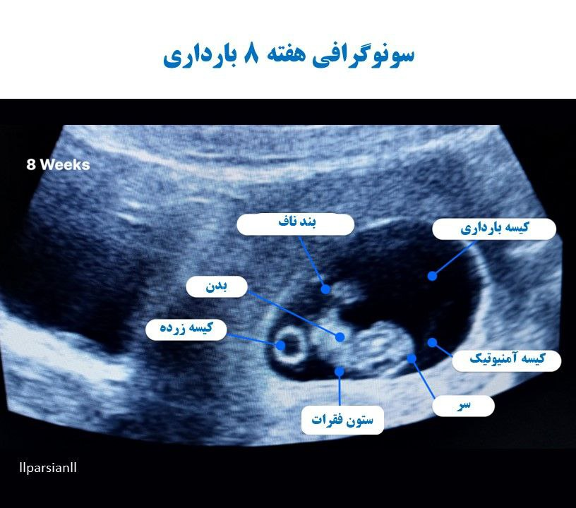 اولین سونوگرافی بارداری چه زمانی انجام میشود؟