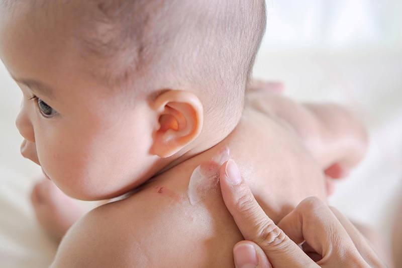 پسوریازیس نوزاد چیست؟